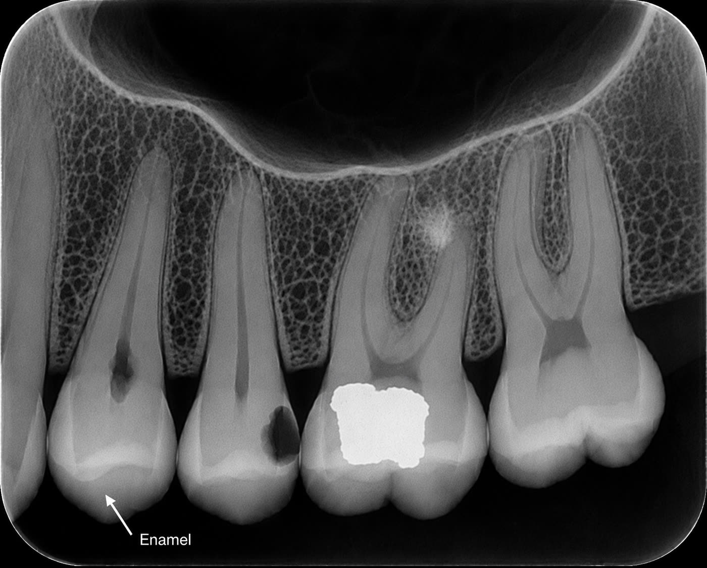 Periapical radiograph with an arrow pointing to the selected structure