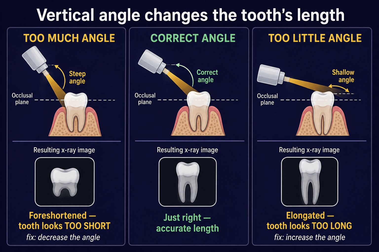 Too much angle makes the tooth foreshortened (too short); correct angle gives accurate length; too little angle makes it elongated (too long).