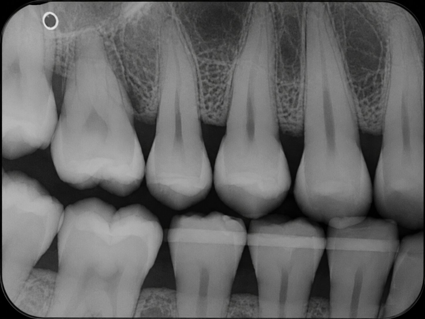 Incorrect bone level bitewing: the crowns of one arch are cut off with too much gum showing, from receptor placed too high or low.