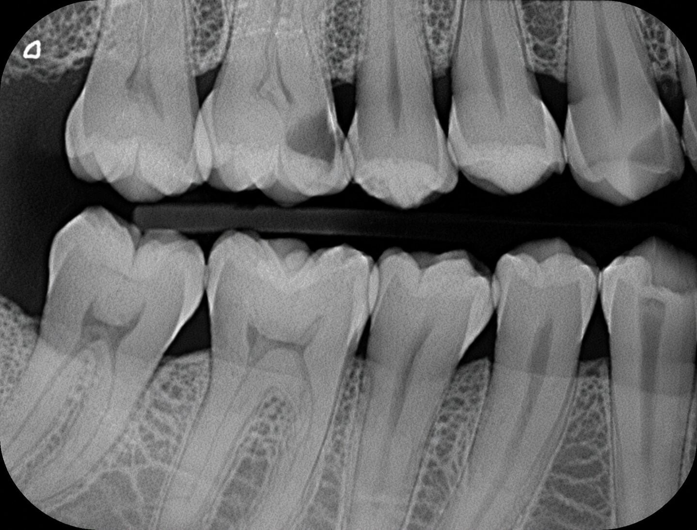 Real bitewing radiograph showing interproximal decay