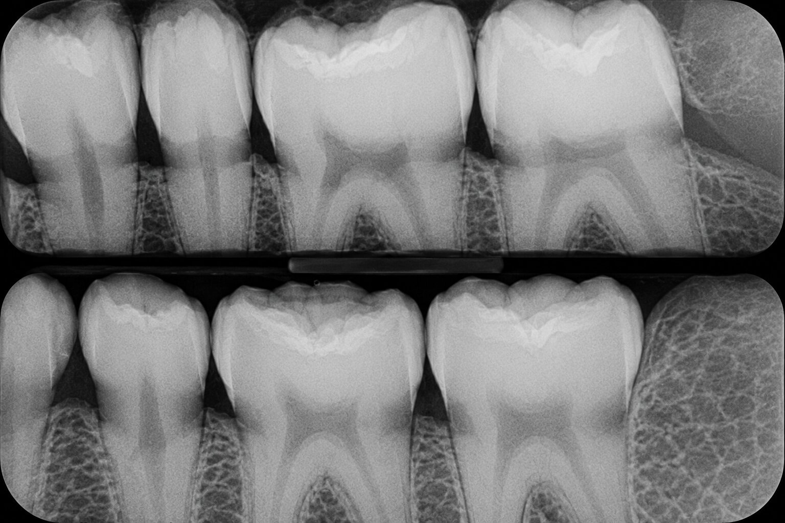 Bitewing radiograph showing cervical burnout