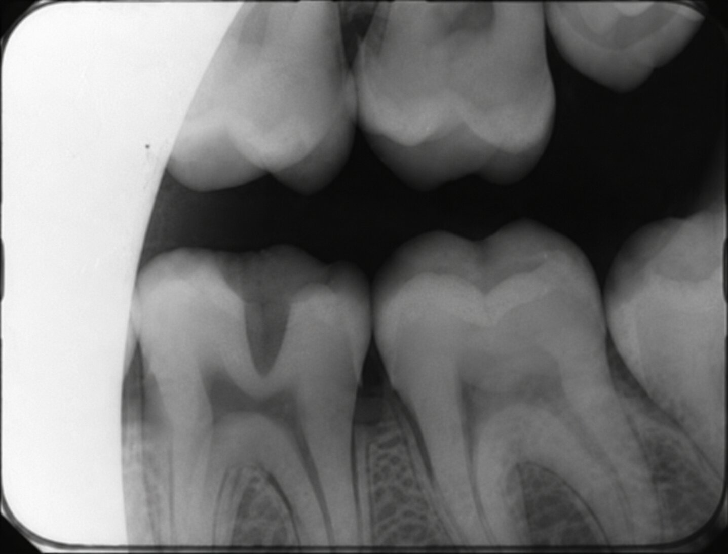 Cone-cut bitewing: a clear curved blank band along one edge with no tooth detail.