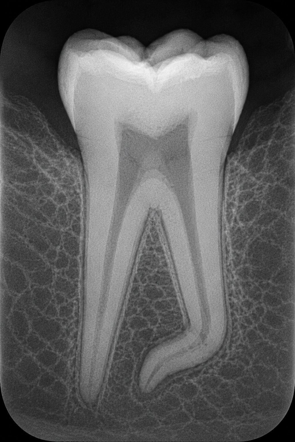 Periapical radiograph showing a dilacerated (sharply bent) root