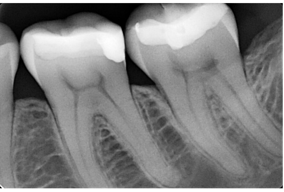 Periapical radiograph