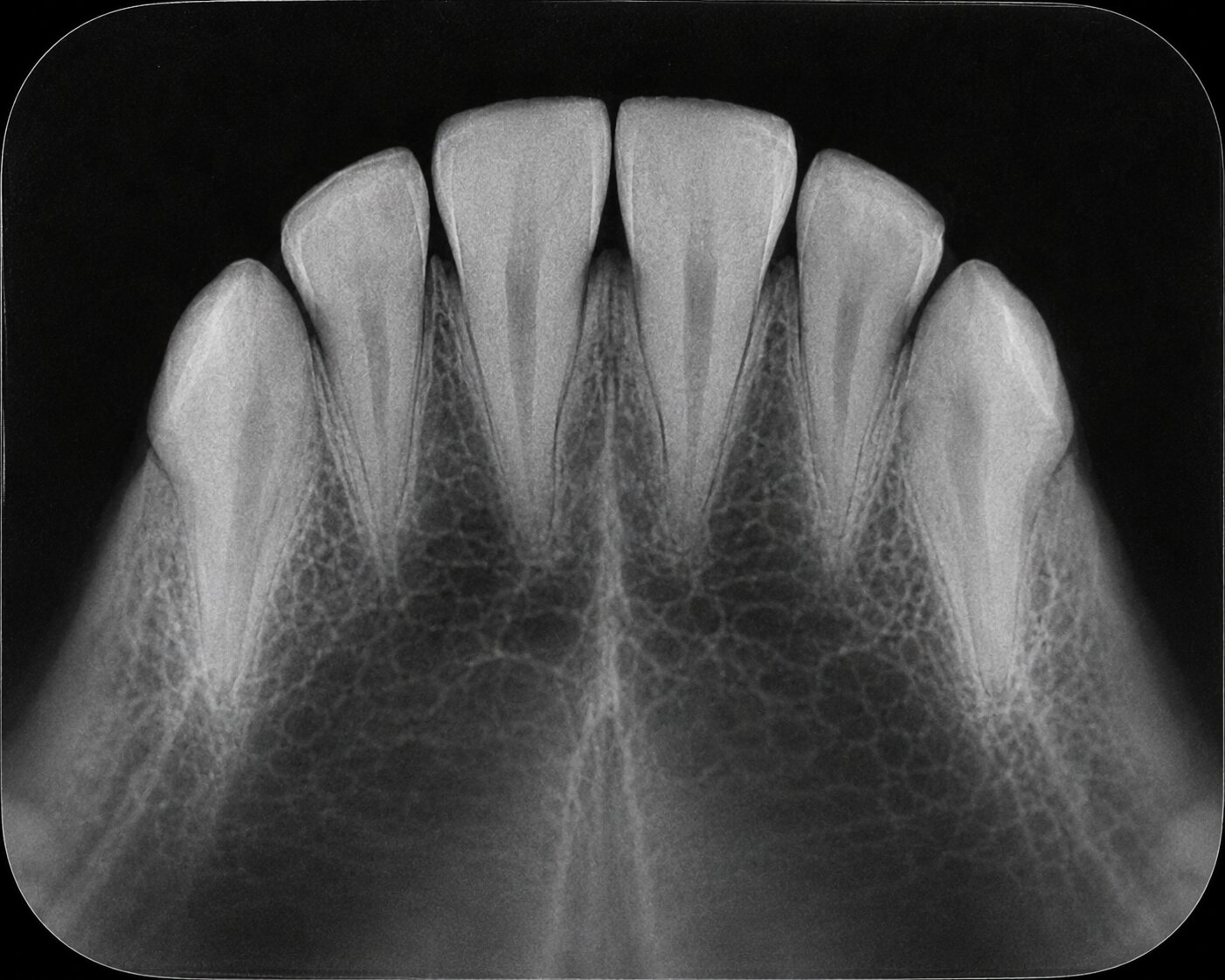 Maxillary occlusal radiograph