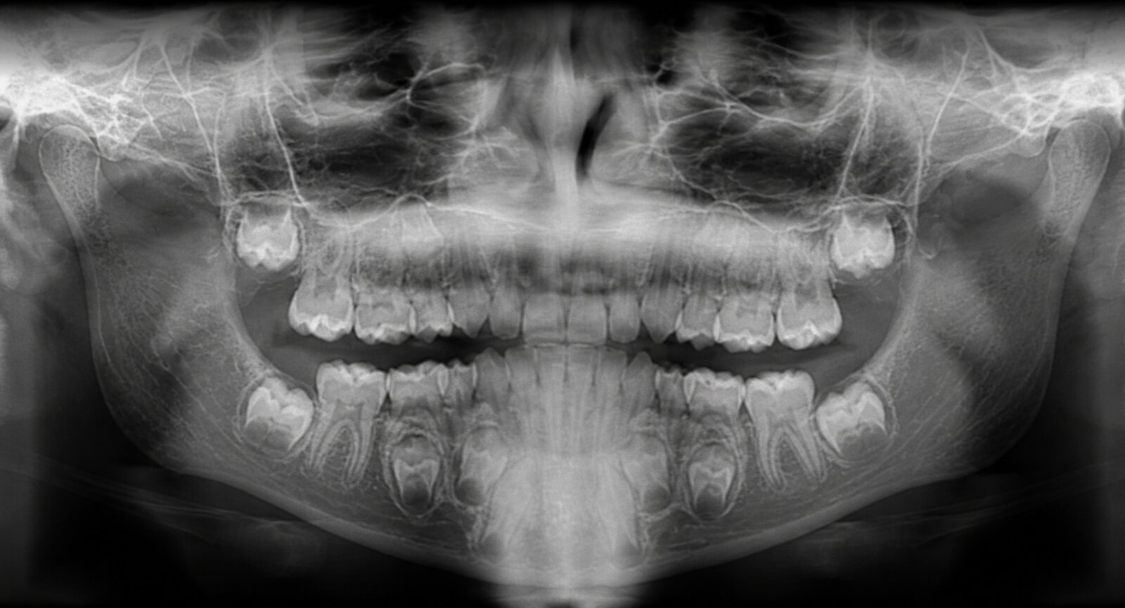 Panoramic radiograph taken with the chin tipped too high: the occlusal plane is flattened and reversed into a downward 'frown' curve, with the maxillary molar roots shadowed by the hard palate and the upper anterior teeth blurred and magnified.