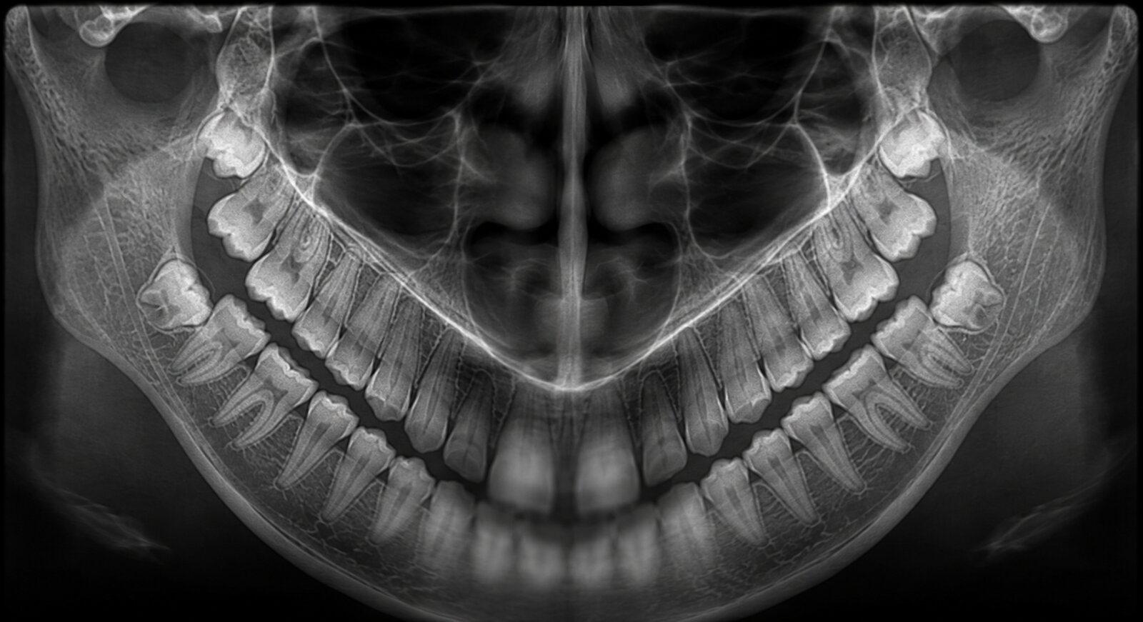 Panoramic radiograph taken with the chin tipped too low: an exaggerated deep 'smile' curve where the anterior teeth dip far down and blur, the roots look shortened, and the condyles are cut off the top edge of the image.