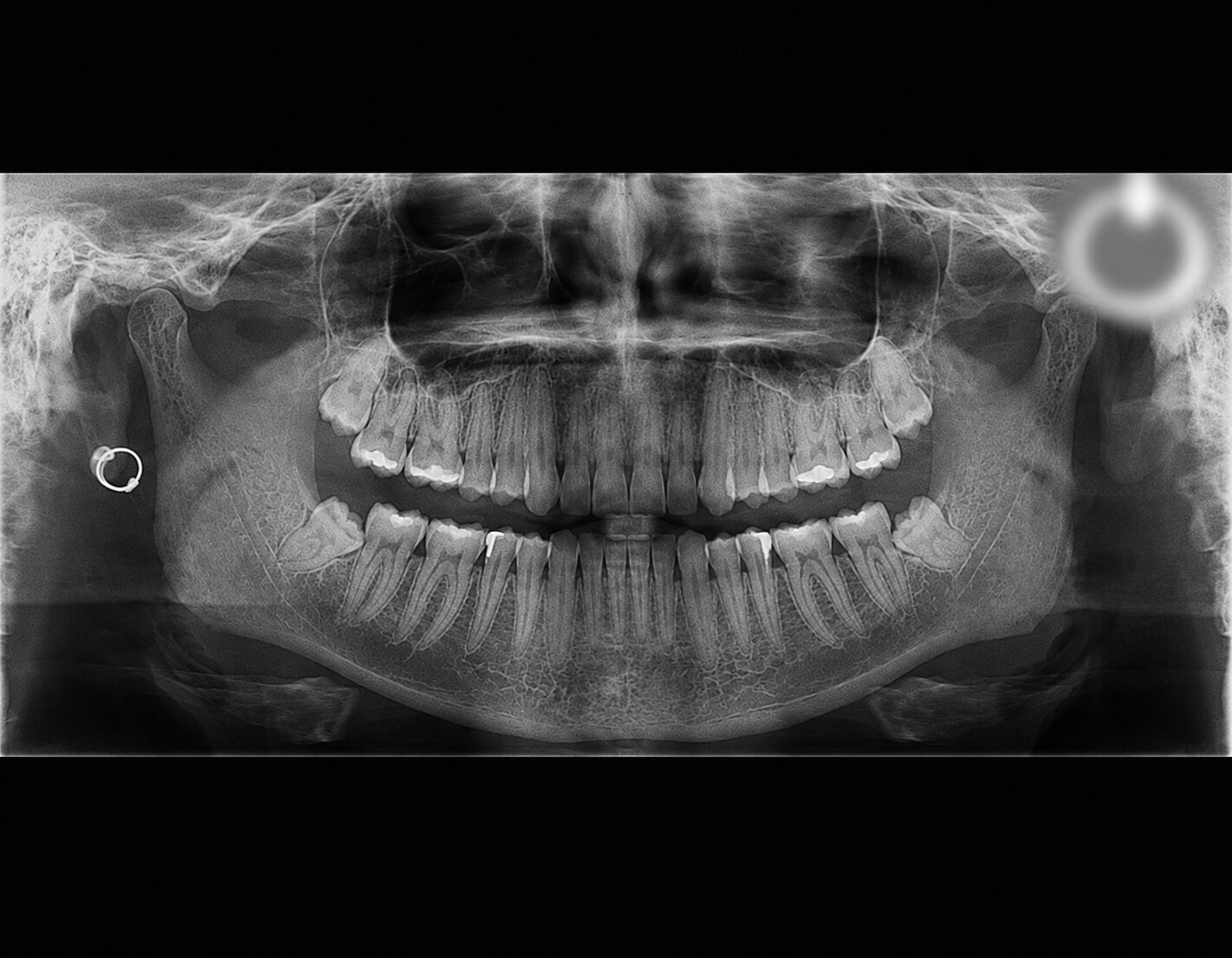 Panoramic radiograph showing a real earring on one side and a larger, blurred ghost duplicate of the same earring higher up on the opposite side, near the ramus/condyle region.