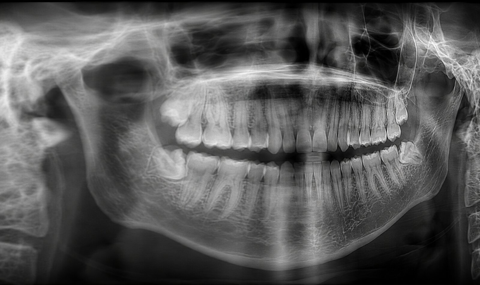 Panoramic radiograph taken with the head rotated off-center: one side's teeth and ramus appear enlarged and blurred while the opposite side looks smaller and sharper, showing clearly uneven left-to-right magnification.
