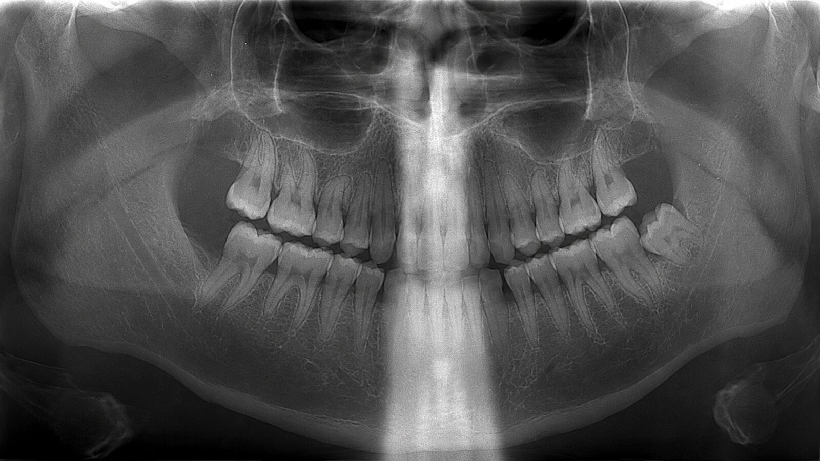 Panoramic radiograph of a slumped patient: a broad radiopaque white column from the cervical spine runs up the center of the image and washes out the anterior teeth.