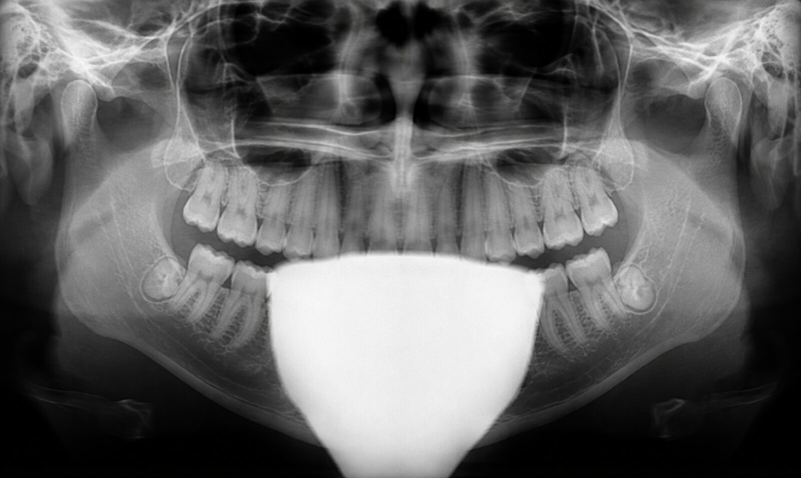 Panoramic radiograph with a large, bright, cone-shaped radiopaque blob across the lower center of the image, blocking the mandibular anterior teeth — the shadow of a lead thyroid collar mistakenly left on during the panoramic exposure.