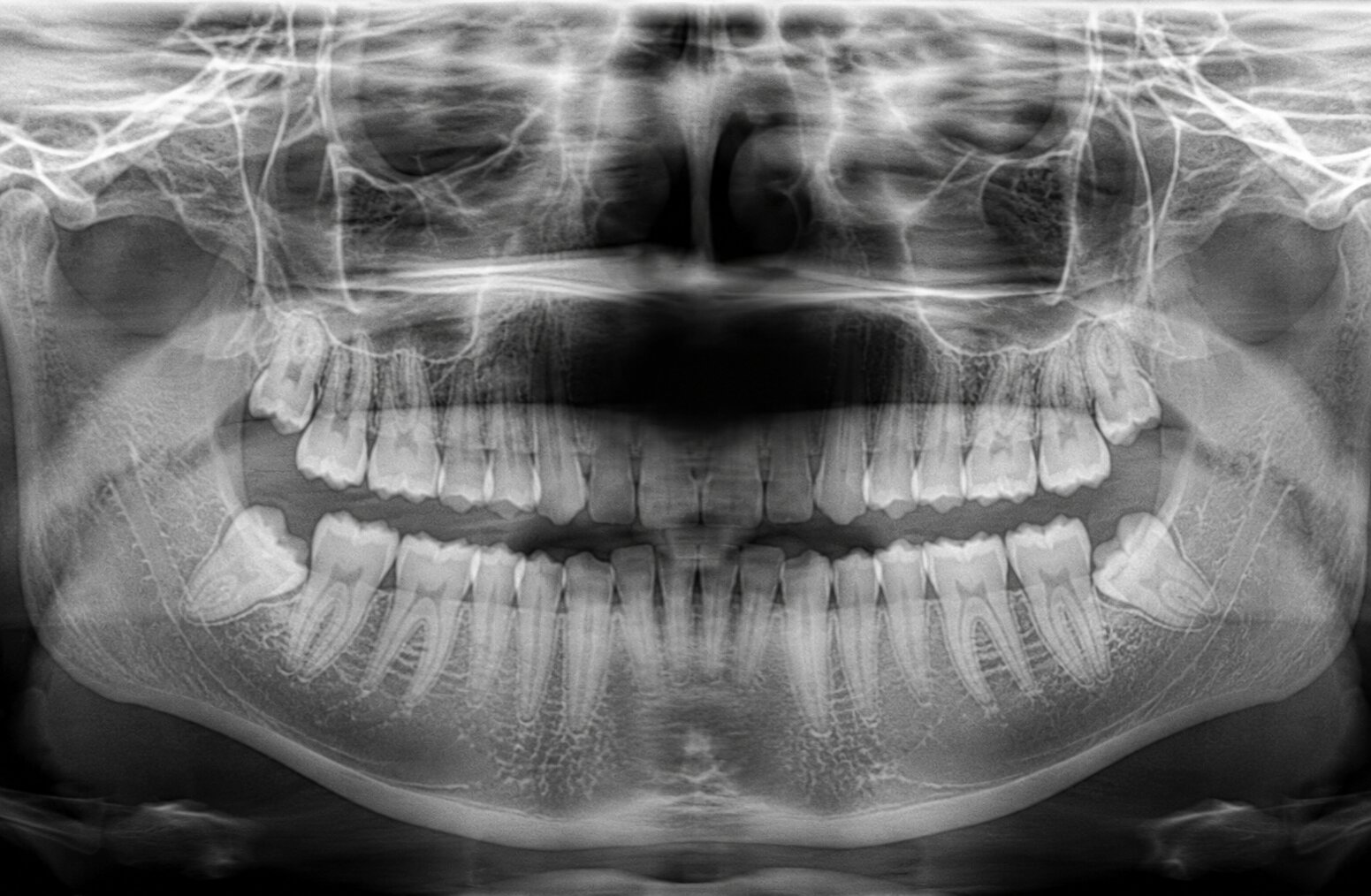 Panoramic radiograph showing a dark radiolucent shadow from the palatoglossal air space washing out the maxillary anterior tooth roots, from the tongue not pressed against the palate during exposure.