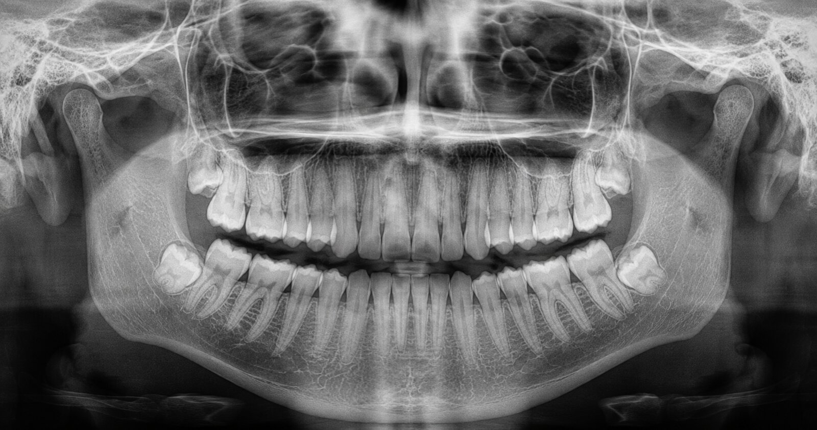 Panoramic radiograph