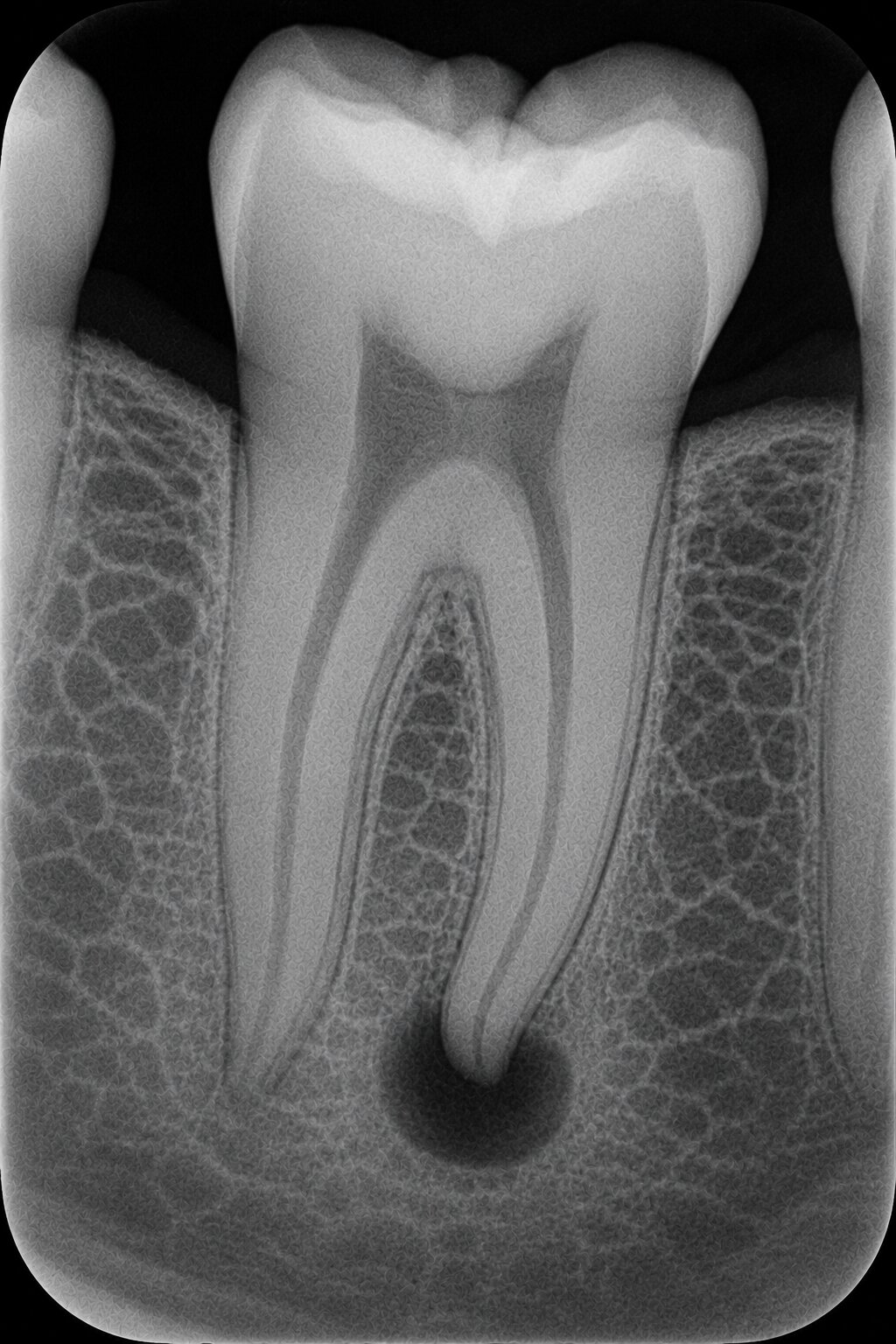 Periapical radiograph showing a radiolucent lesion at the root apex