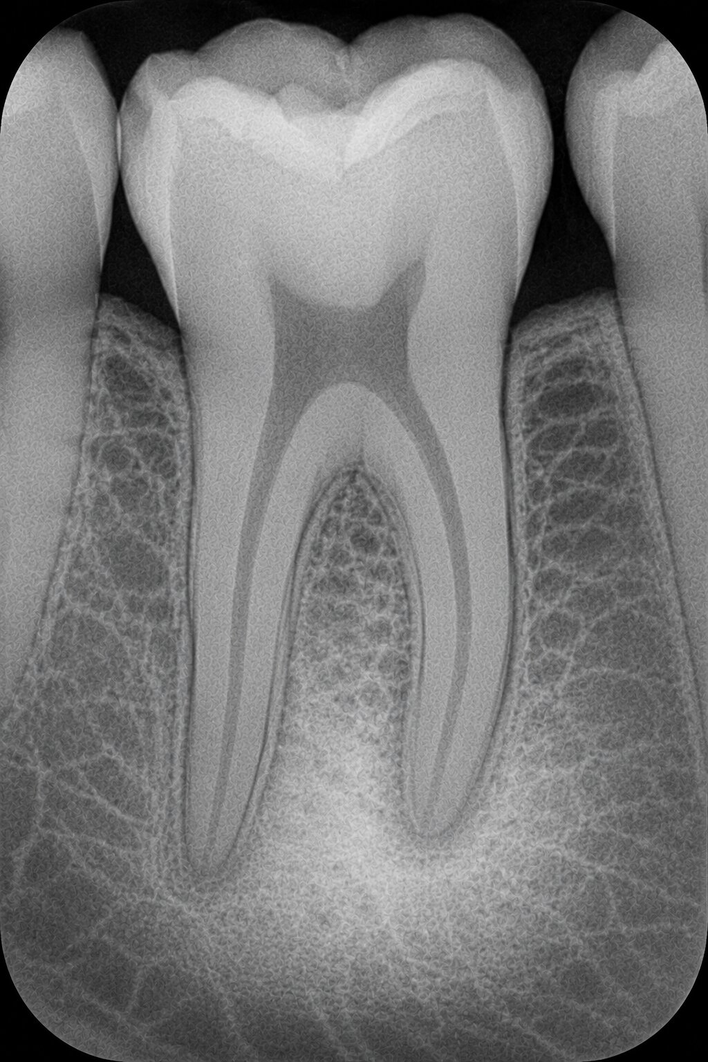 Periapical radiograph showing sclerotic (condensing) bone near a root apex